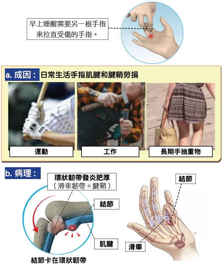 Trigger finger overview